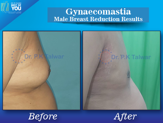 Gynaecomastia before after image